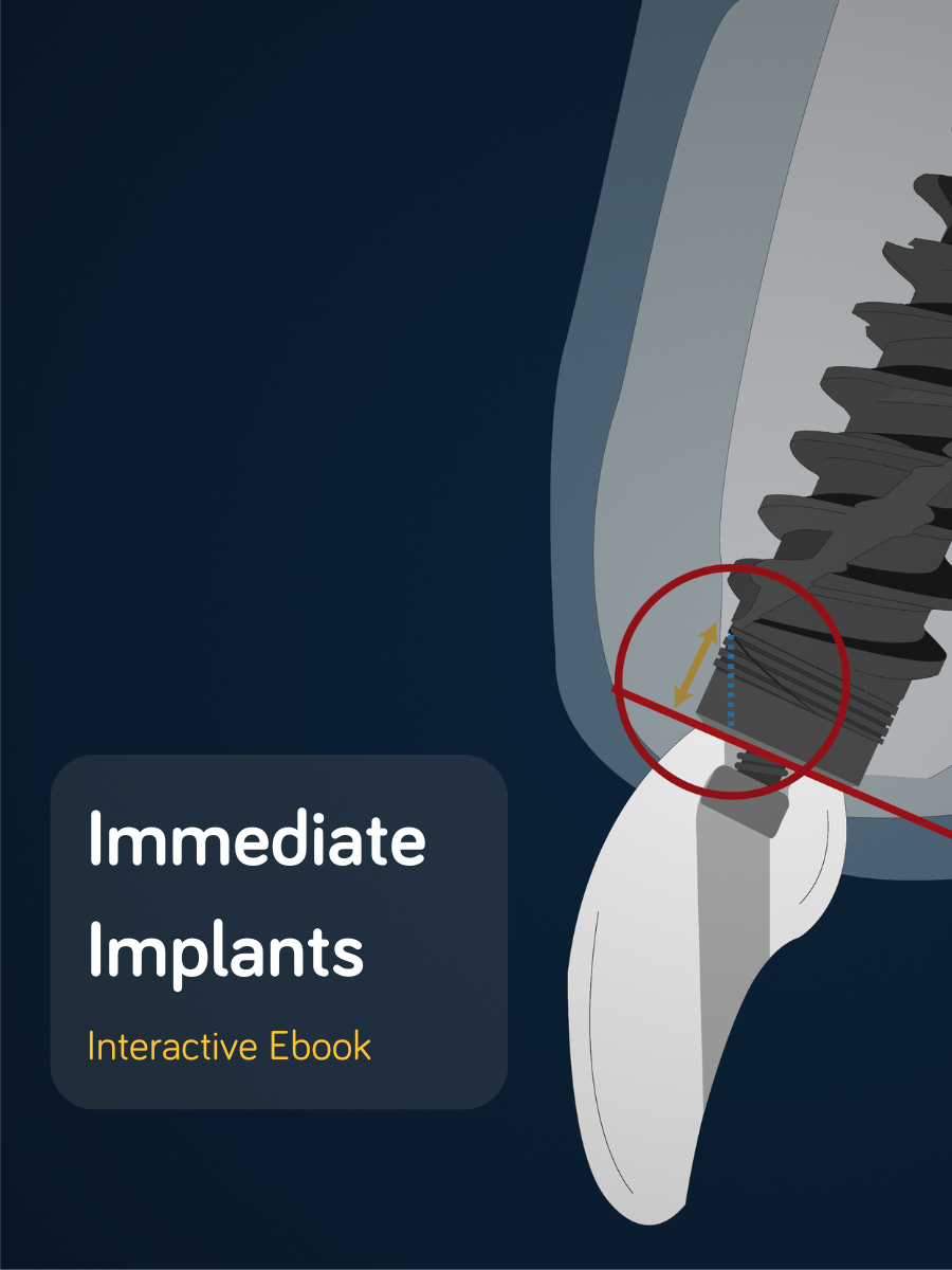 Immediate Implants