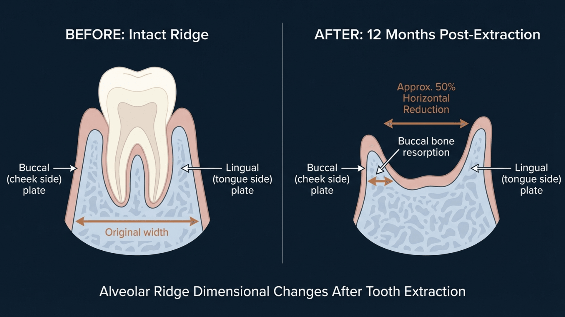 Before and after comparison showing 50% buccal width reduction following tooth extraction