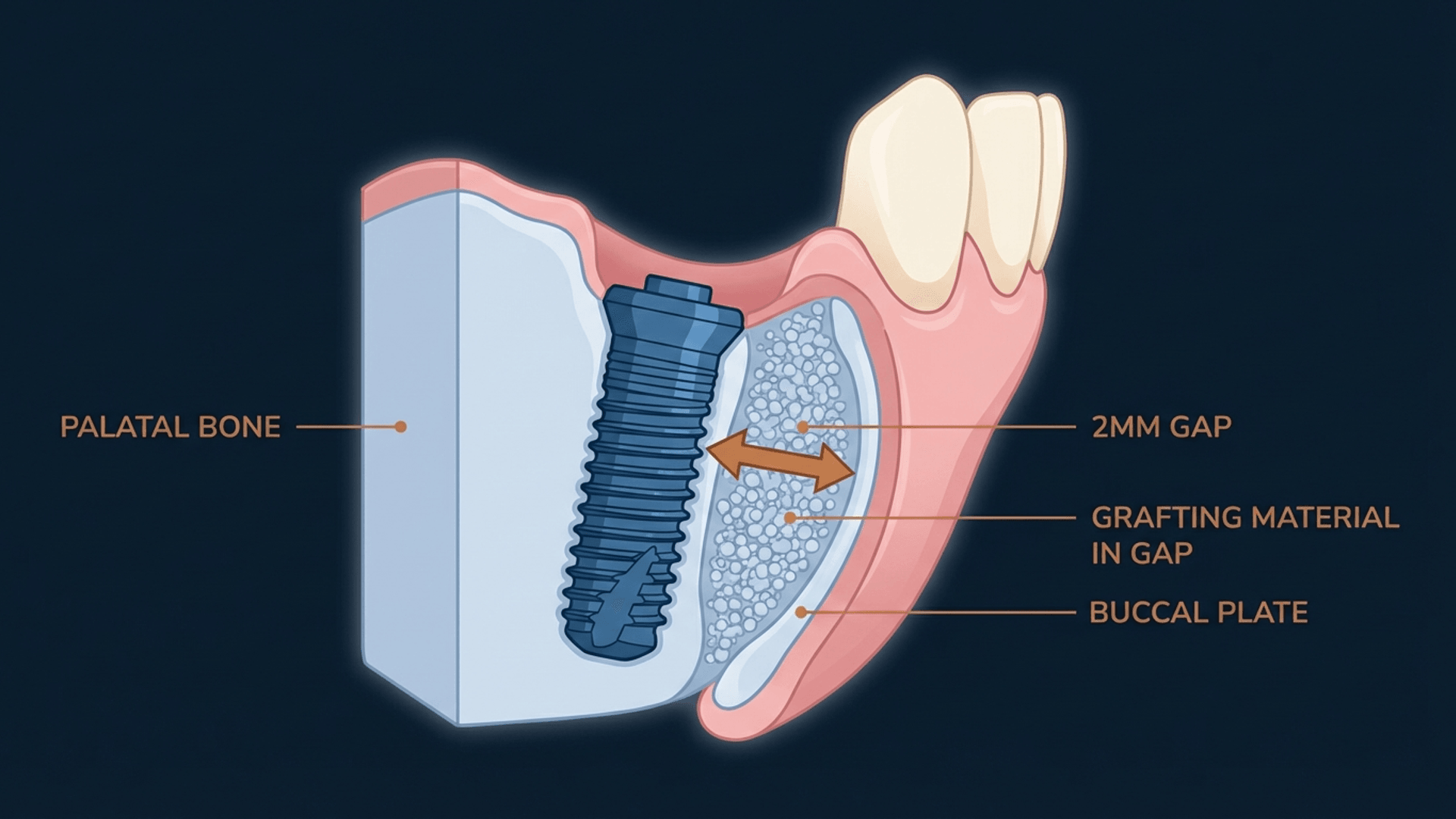Immediate implant placement showing critical 2mm buccal gap with grafting material