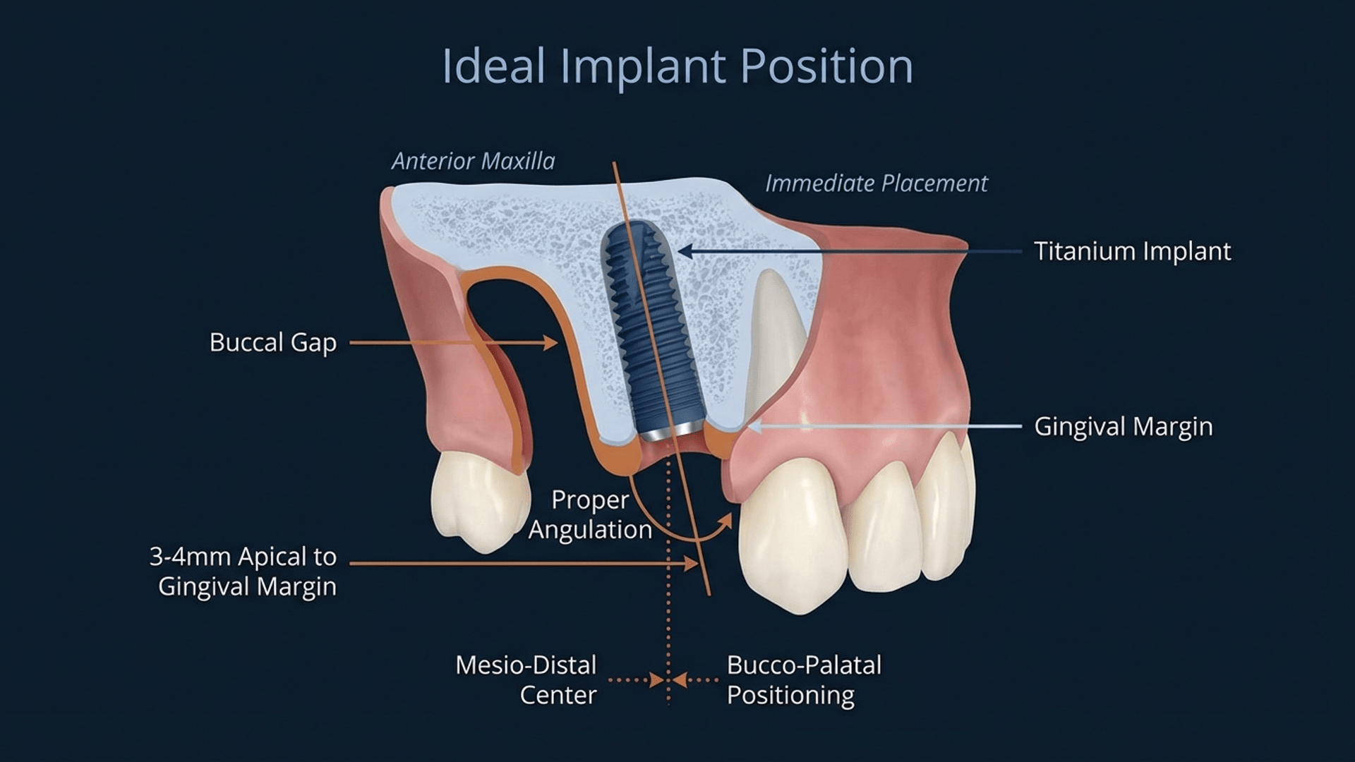 Ideal implant position in anterior maxilla showing proper 3D placement
