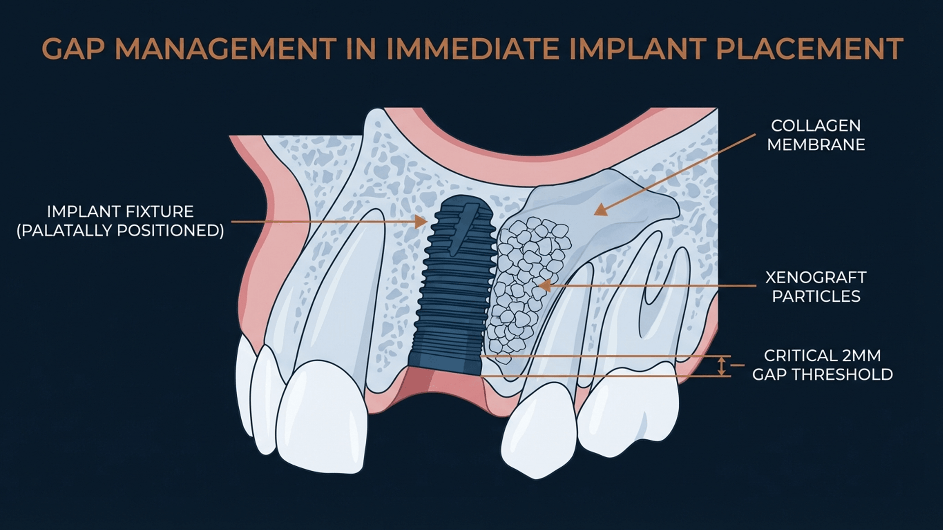 Gap management with bone grafting in immediate implant placement