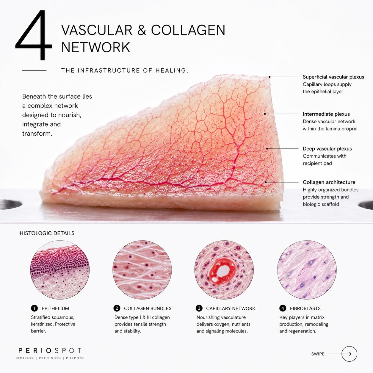 Histologic view of connective tissue graft revascularization: capillary networks nourishing the graft and fibroblasts remodeling the matrix