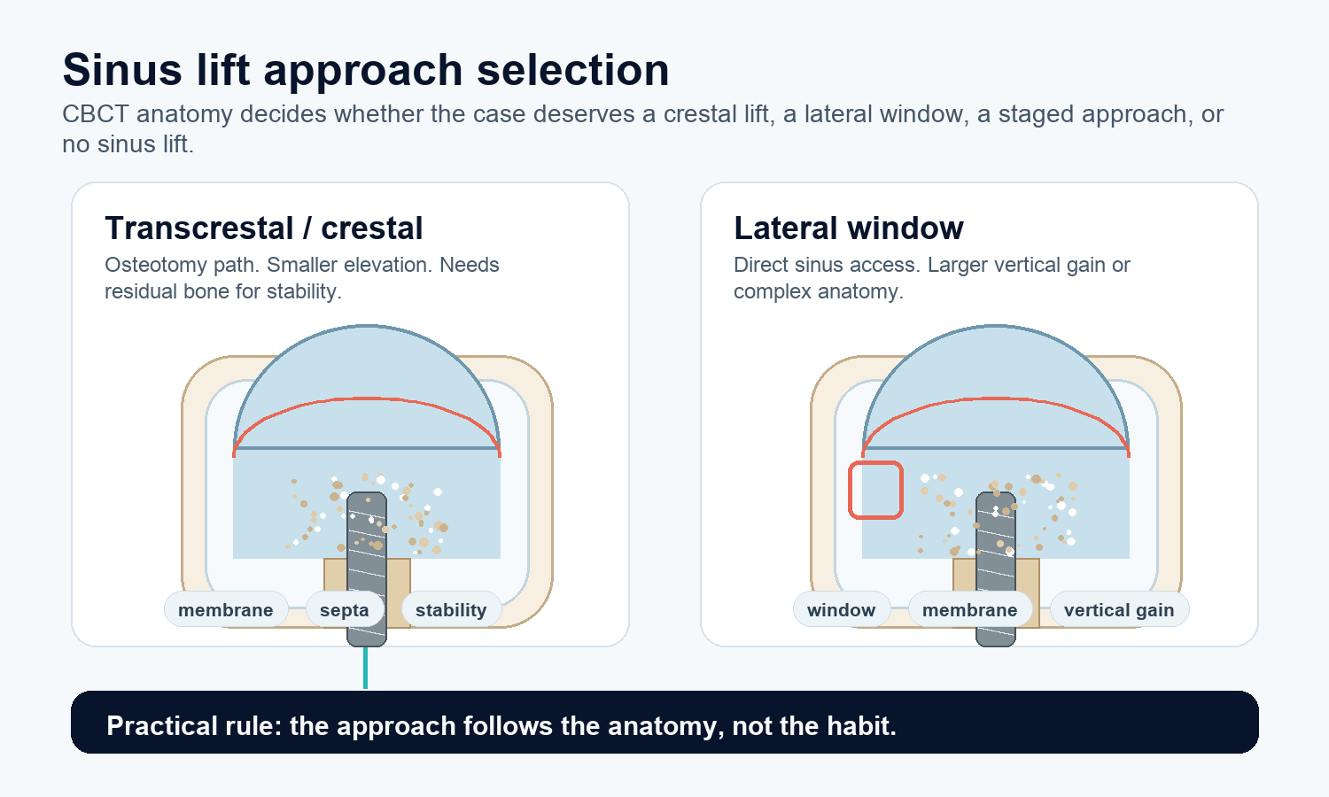 Sinus lift approach selection diagram comparing transcrestal and lateral window access