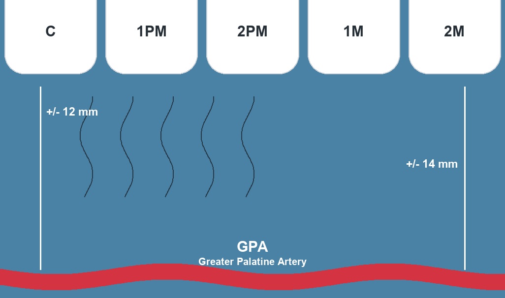 Palatal anatomy and greater palatine artery landmarks for connective tissue graft harvesting