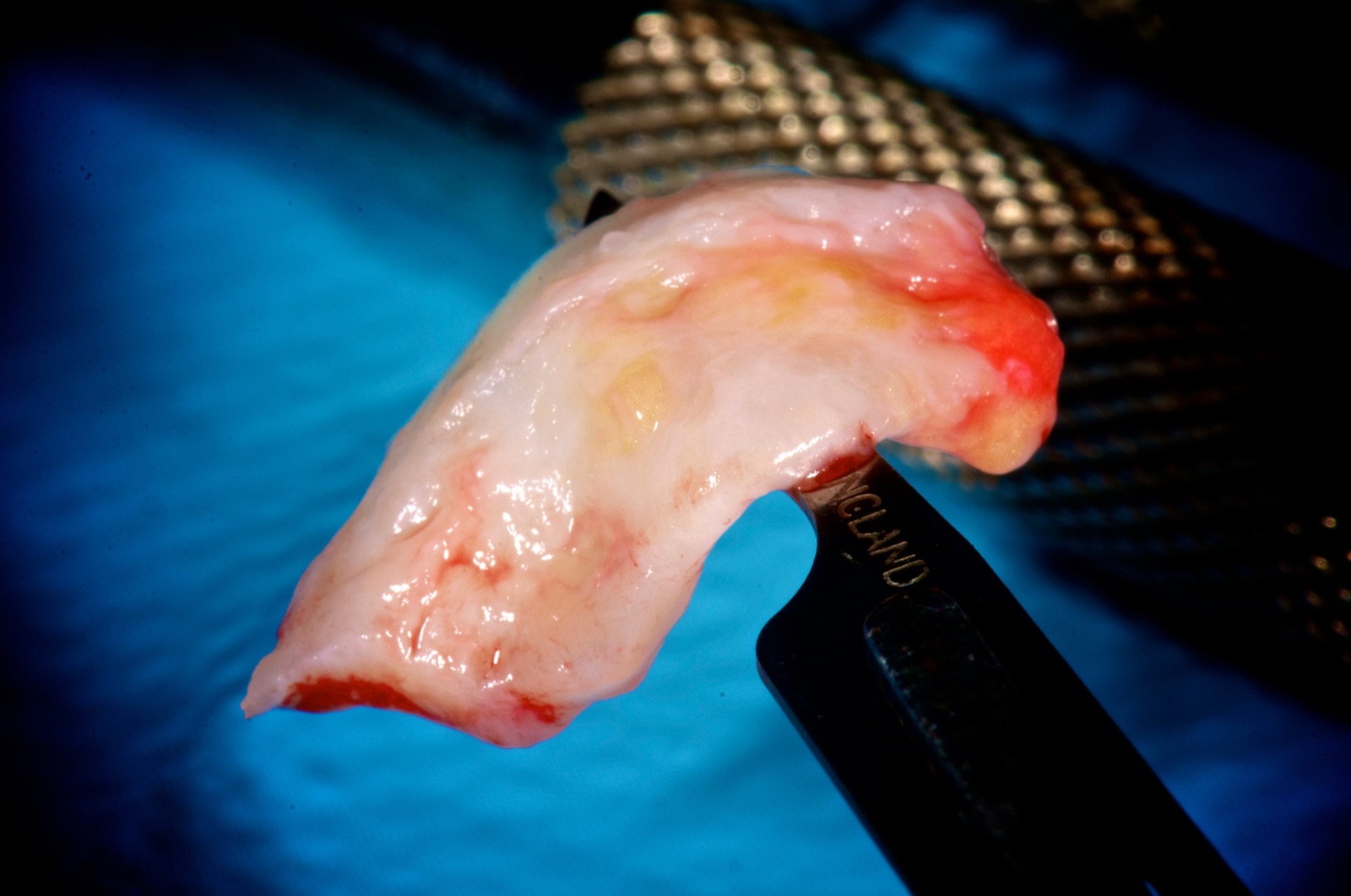 A thick connective tissue graft held in tissue forceps immediately after harvesting.