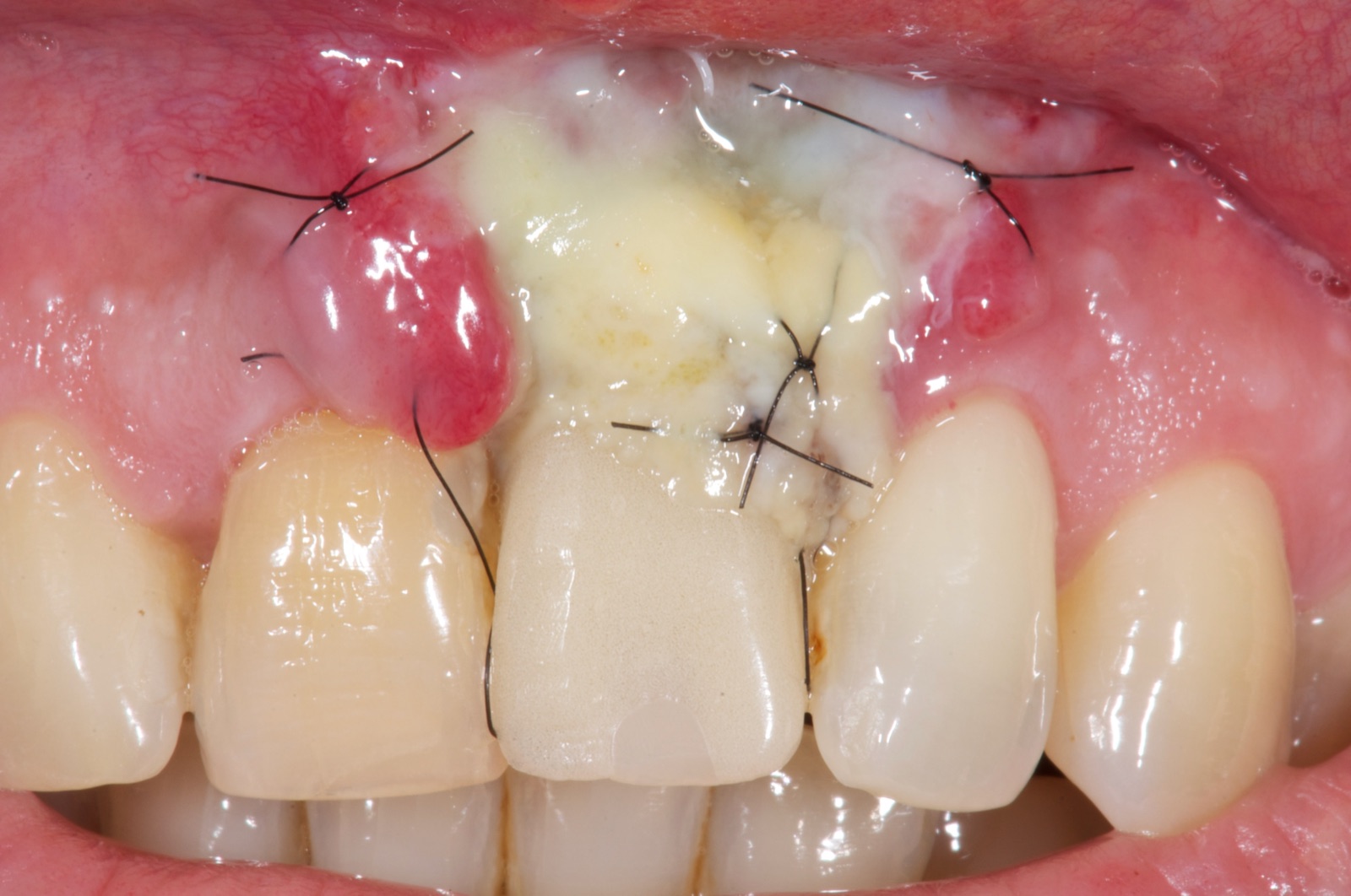 Healing intraoral view showing a whitish, sloughing, partially necrotic graft with sutures and inflamed papillae in the maxillary anterior.