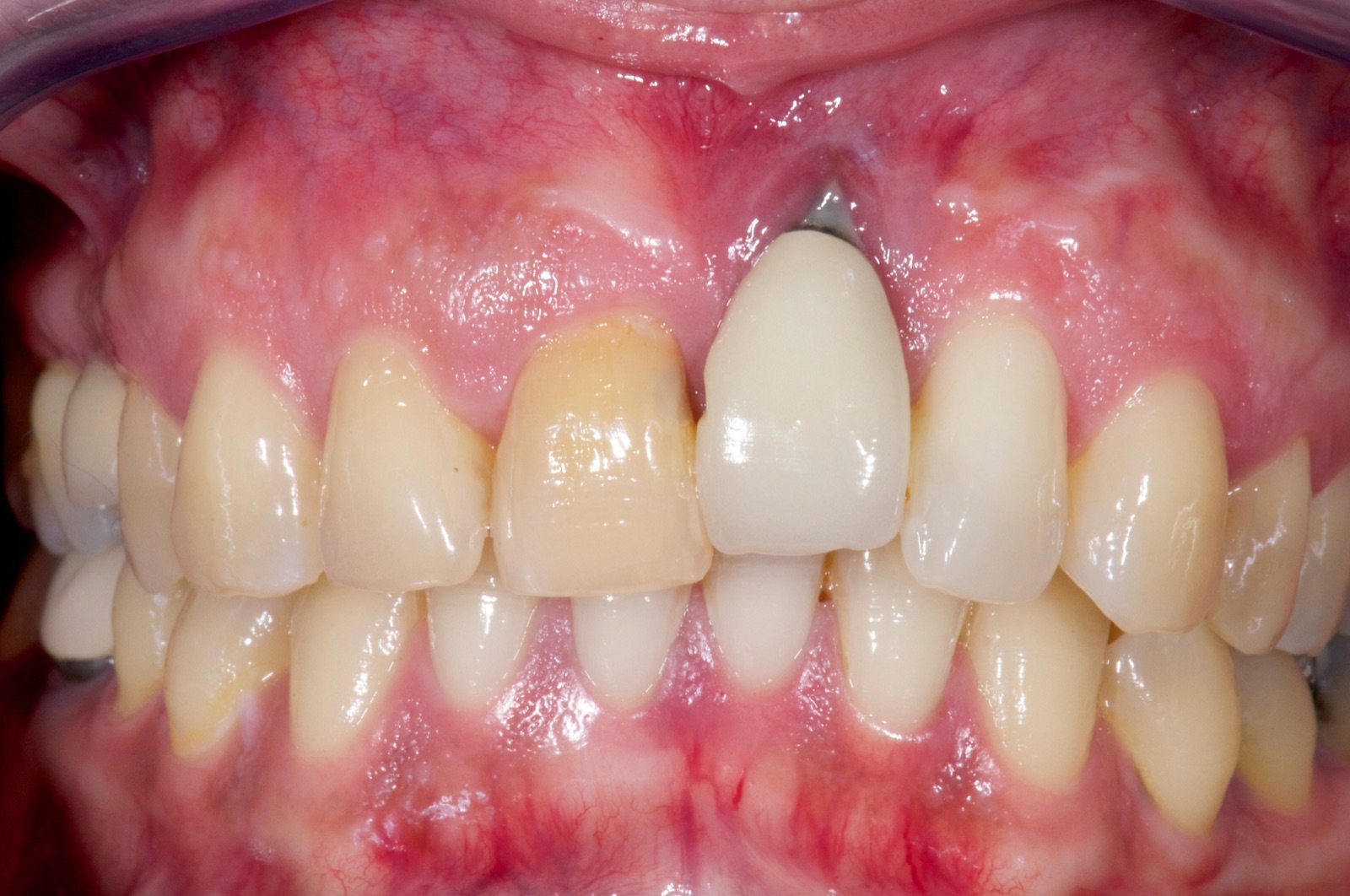 Frontal intraoral photograph of the maxillary anterior showing a missing central incisor site, a discolored adjacent tooth, and thin, scarred gingiva.