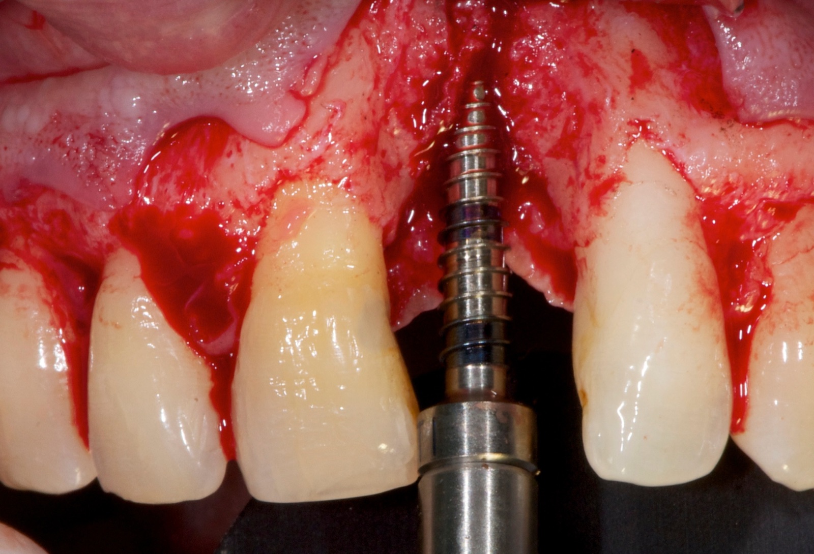 Surgical view of a flap raised in the maxillary anterior with an implant being placed at the central incisor position.