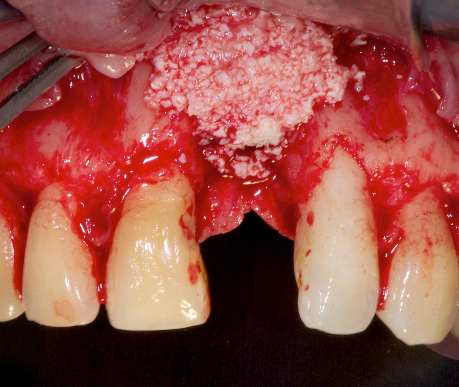 Particulate bone graft packed over the facial aspect of the ridge around the implant during guided bone regeneration.