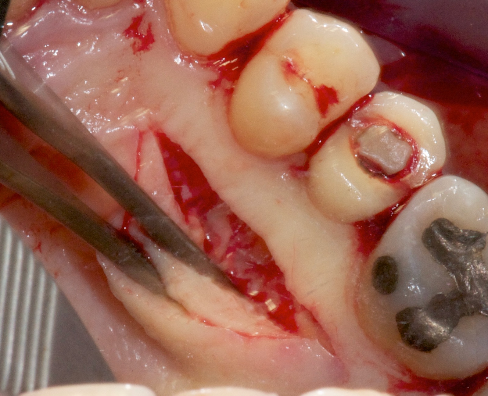 Intraoral surgical view of the posterior palate with a flap elevated at the connective tissue graft donor site.