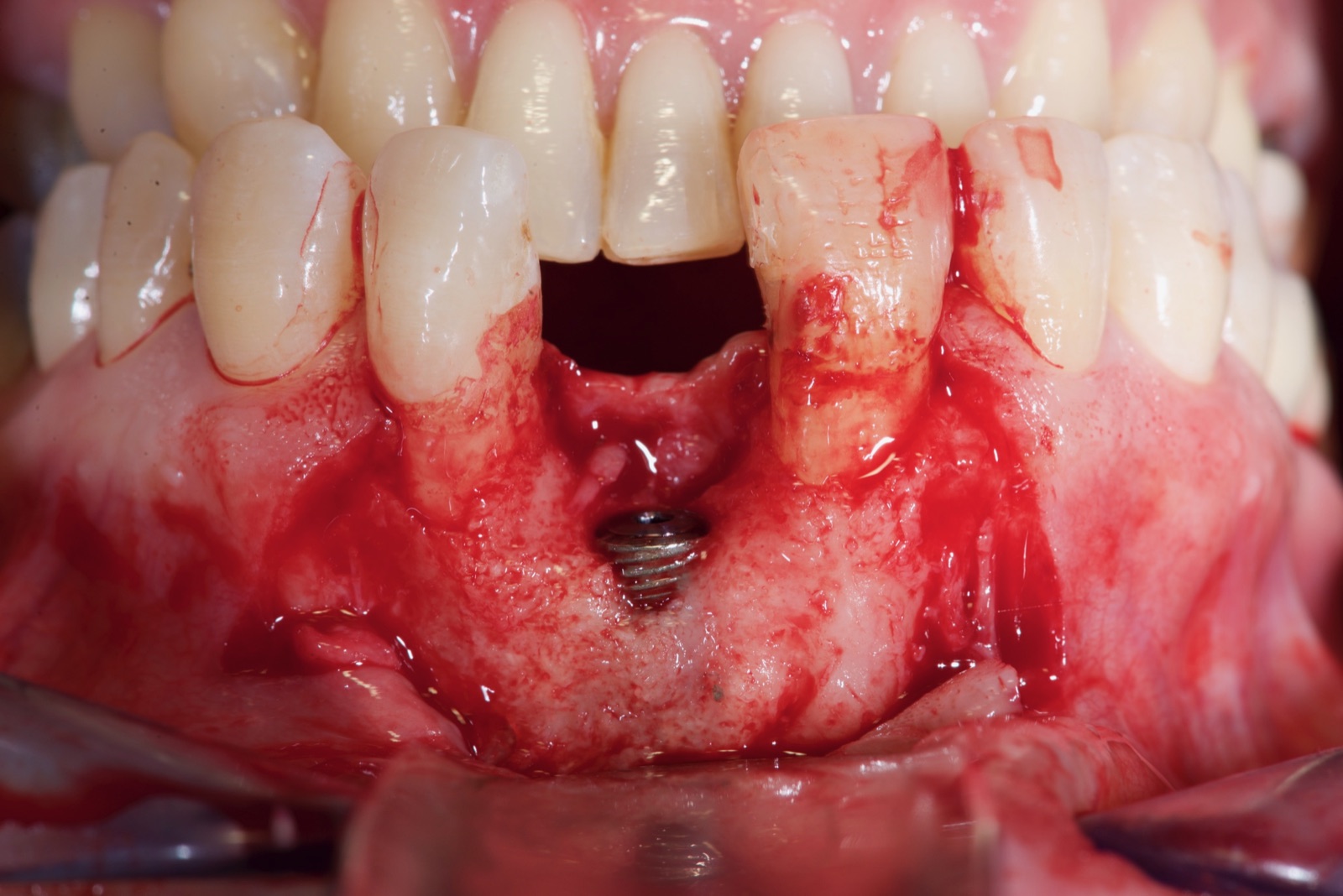 Surgical view showing the exposed head of a dental implant through a bony dehiscence in the maxillary anterior.