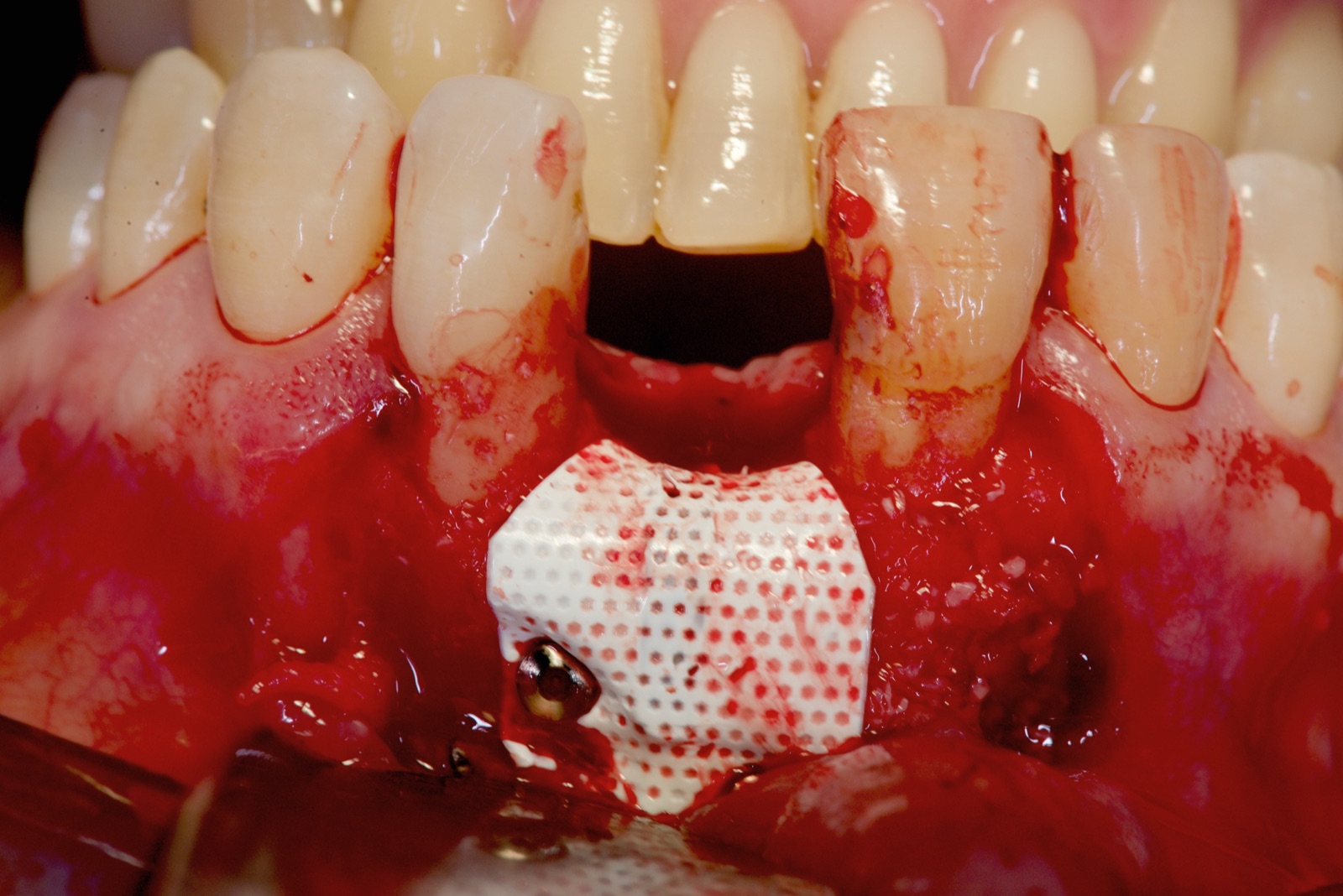 Surgical view of a perforated reinforced membrane fixed with a screw over particulate bone graft during vertical bone augmentation in the maxillary anterior.