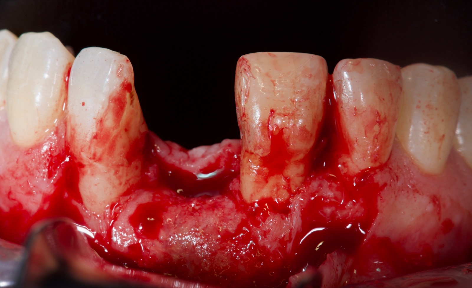 Surgical re-entry of the maxillary anterior after removal of the reinforced membrane, showing regenerated bone at the ridge.