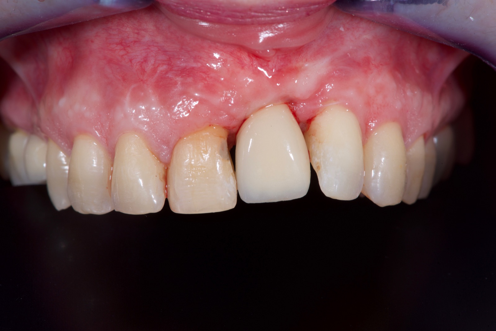 Later frontal intraoral view of the maxillary anterior with the restored central incisor and healed but scarred gingiva.