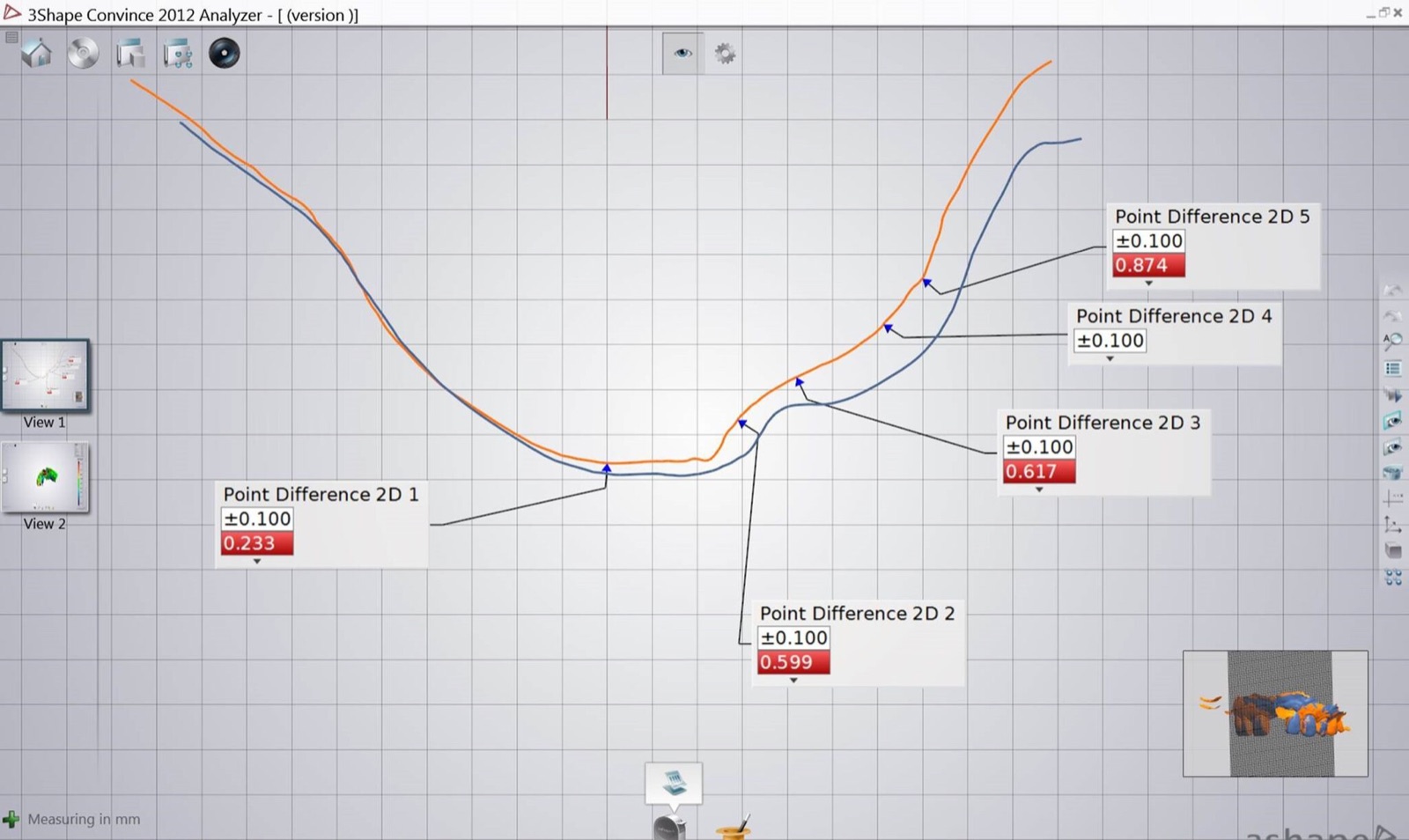 A 3Shape digital analysis screen overlaying two ridge profiles, orange and blue, with point-to-point differences measured between roughly 0.23 and 0.87 millimeters.