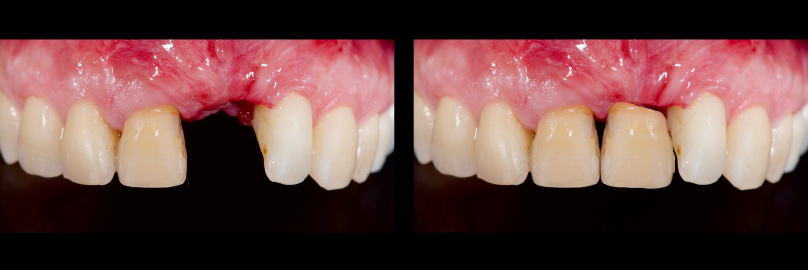 Before and after digital simulation of the maxillary anterior: on the left the healed site, on the right the simulated final tooth.