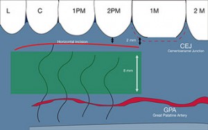 Técnicas de injerto de tejido conectivo. Arteria palatina mayor