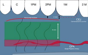 Técnicas de injerto de tejido conectivo. Arteria palatina mayor