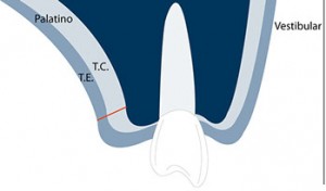 Técnicas de injerto de tejido conectivo paso 1