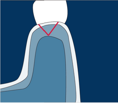 Técnicas de injerto de tejido conectivo de la tuberosidad
