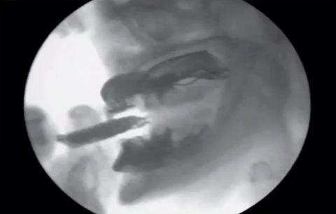 Periospot GIF downsized large