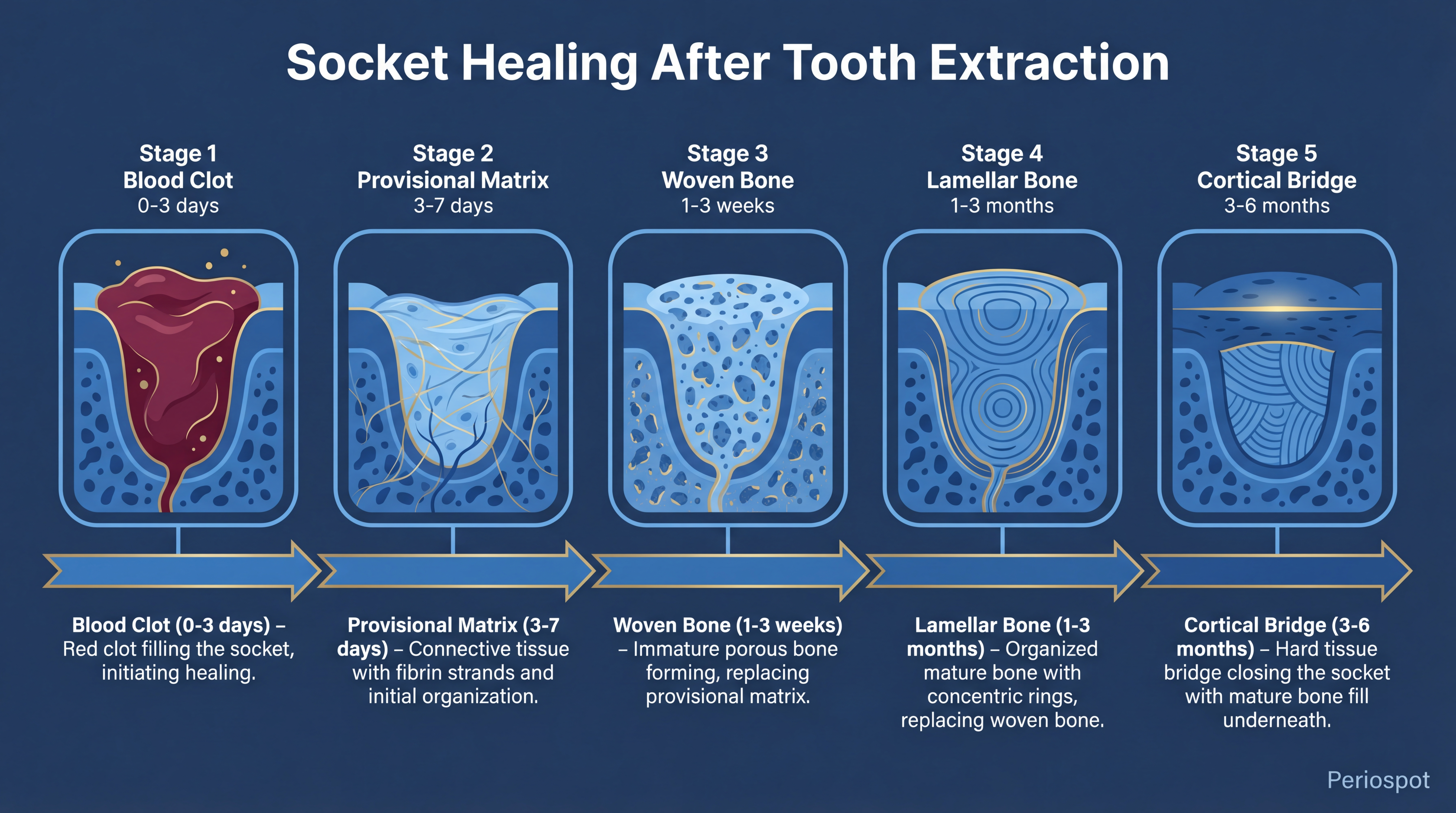 Socket healing timeline after tooth extraction showing 5 stages: blood clot, provisional matrix, woven bone, lamellar bone, and cortical bridge formation